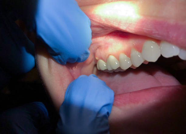 Best Emergency Wisdom Teeth Removal in Meadows Place, TX